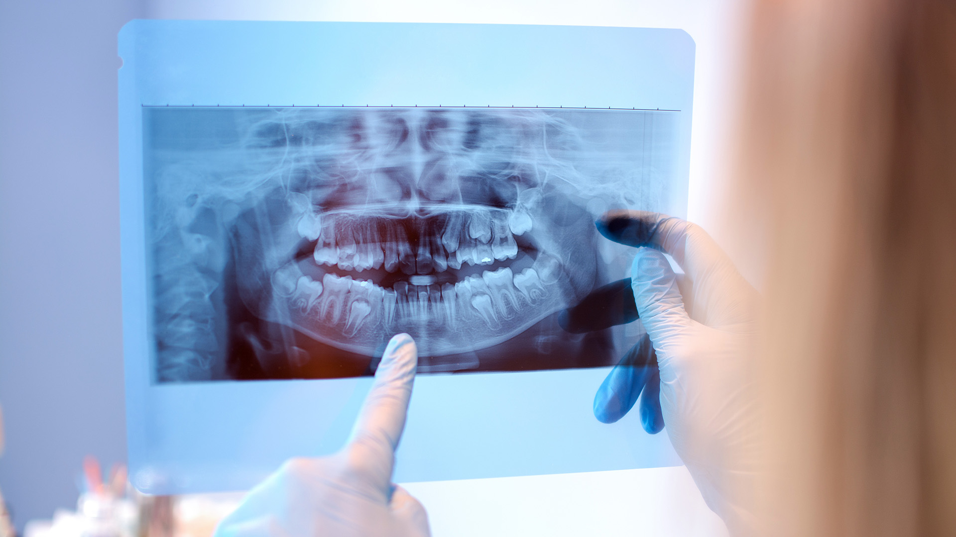 Bone Grafting