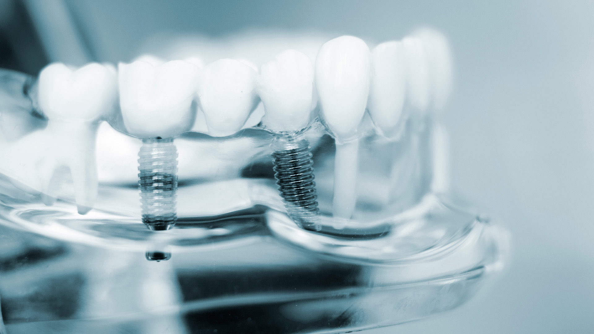 Types of Dental Implants Your Complete Guide