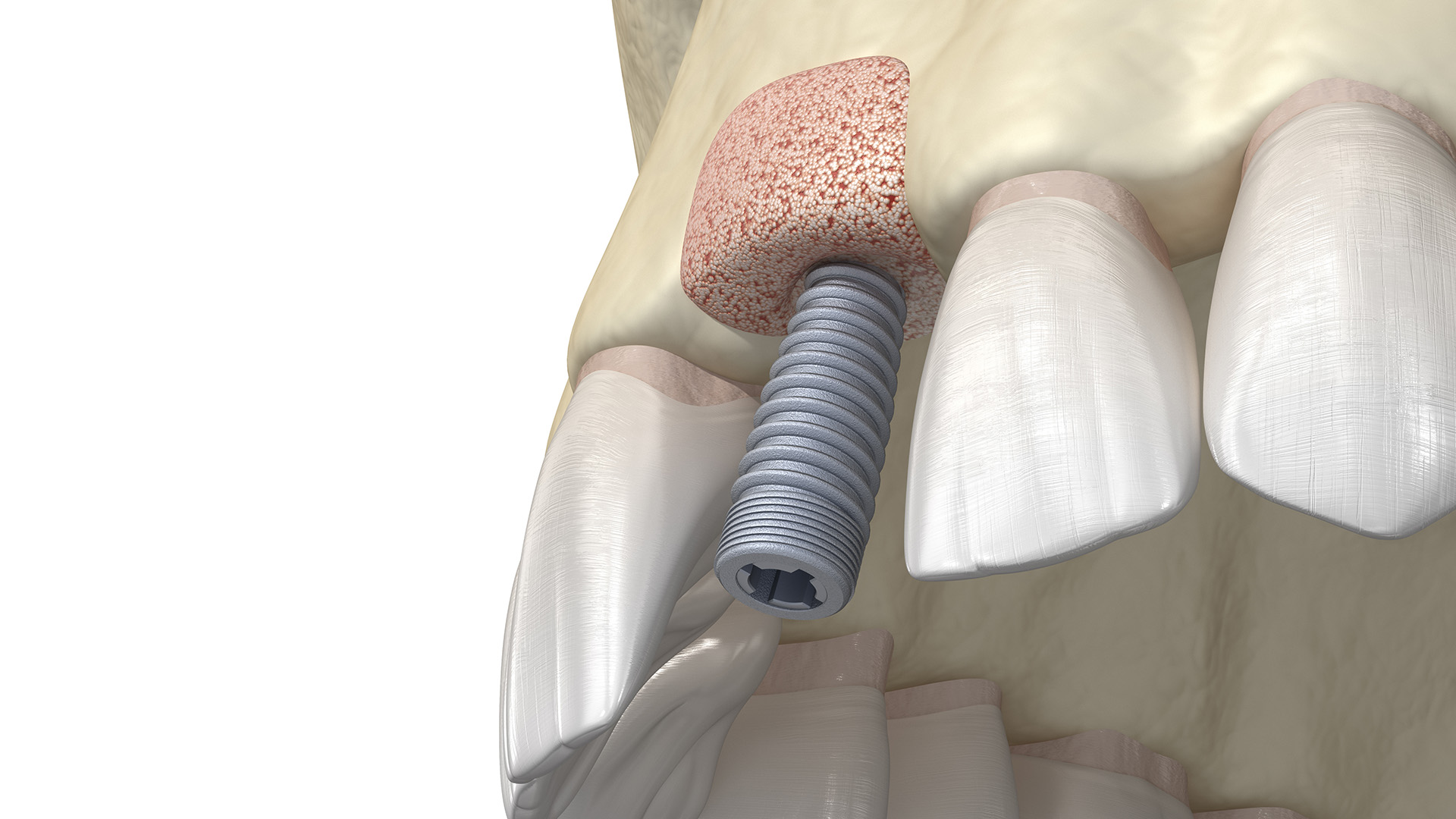 Why You May Need Bone Grafting