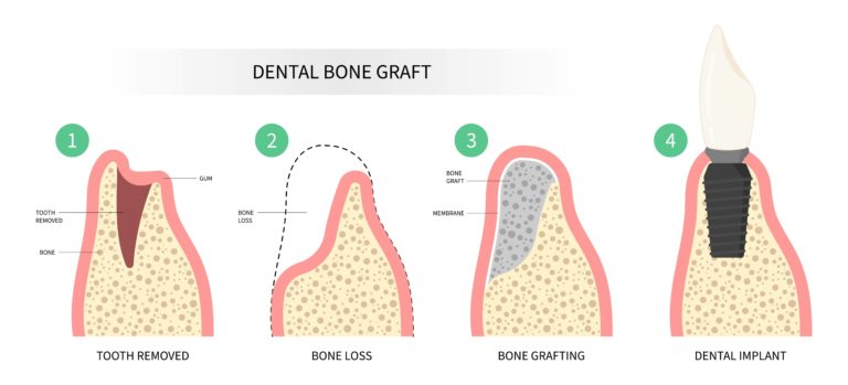 Bone Grafting in Fort Smith, AR