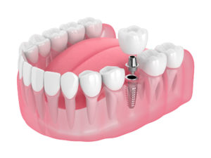 Dental Implants in Fort Smith, AR