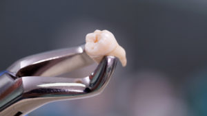 Tooth Extractions in Conway AR