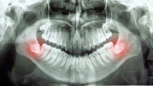 Wisdom Tooth Extractions in Russellville, AR