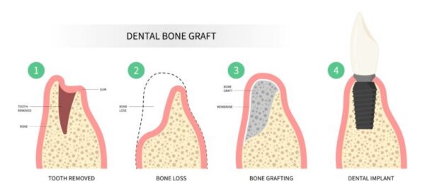 Bone Grafting in Russellville AR