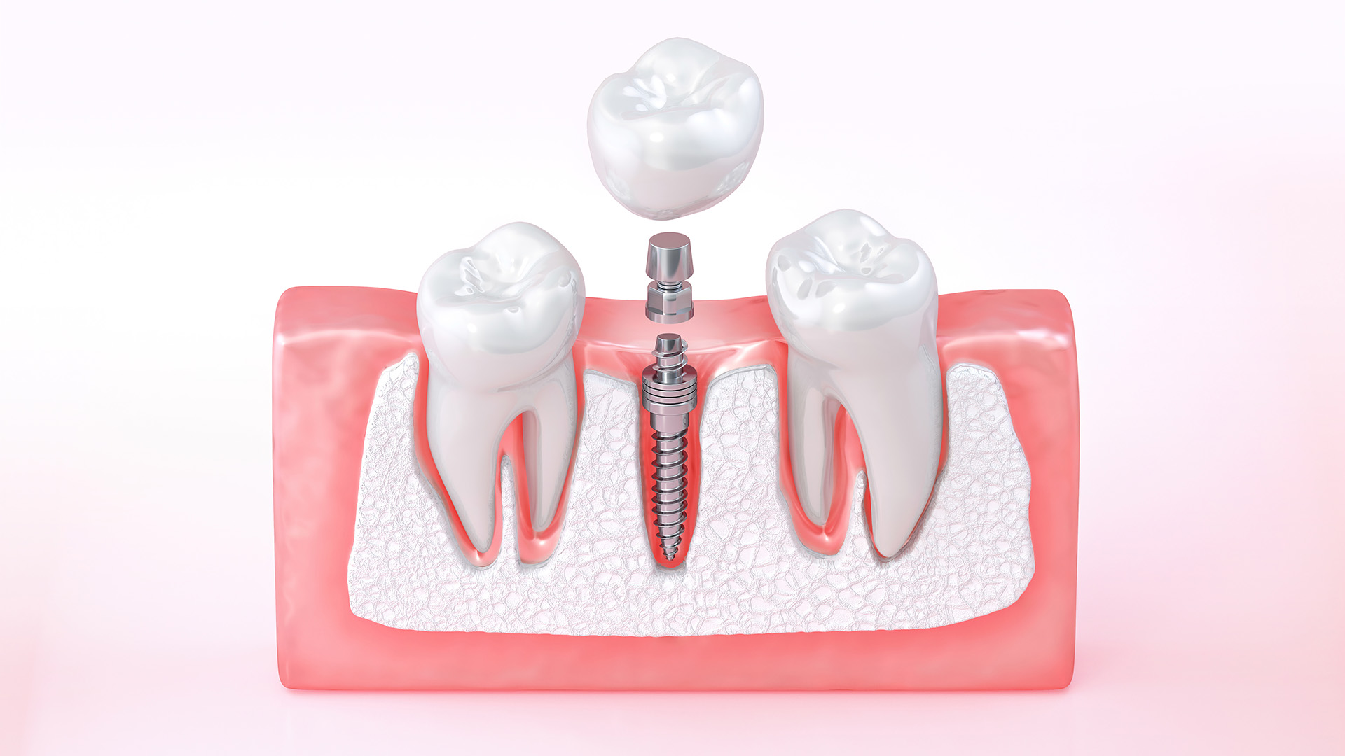 Bone Grafting in Conway, AR