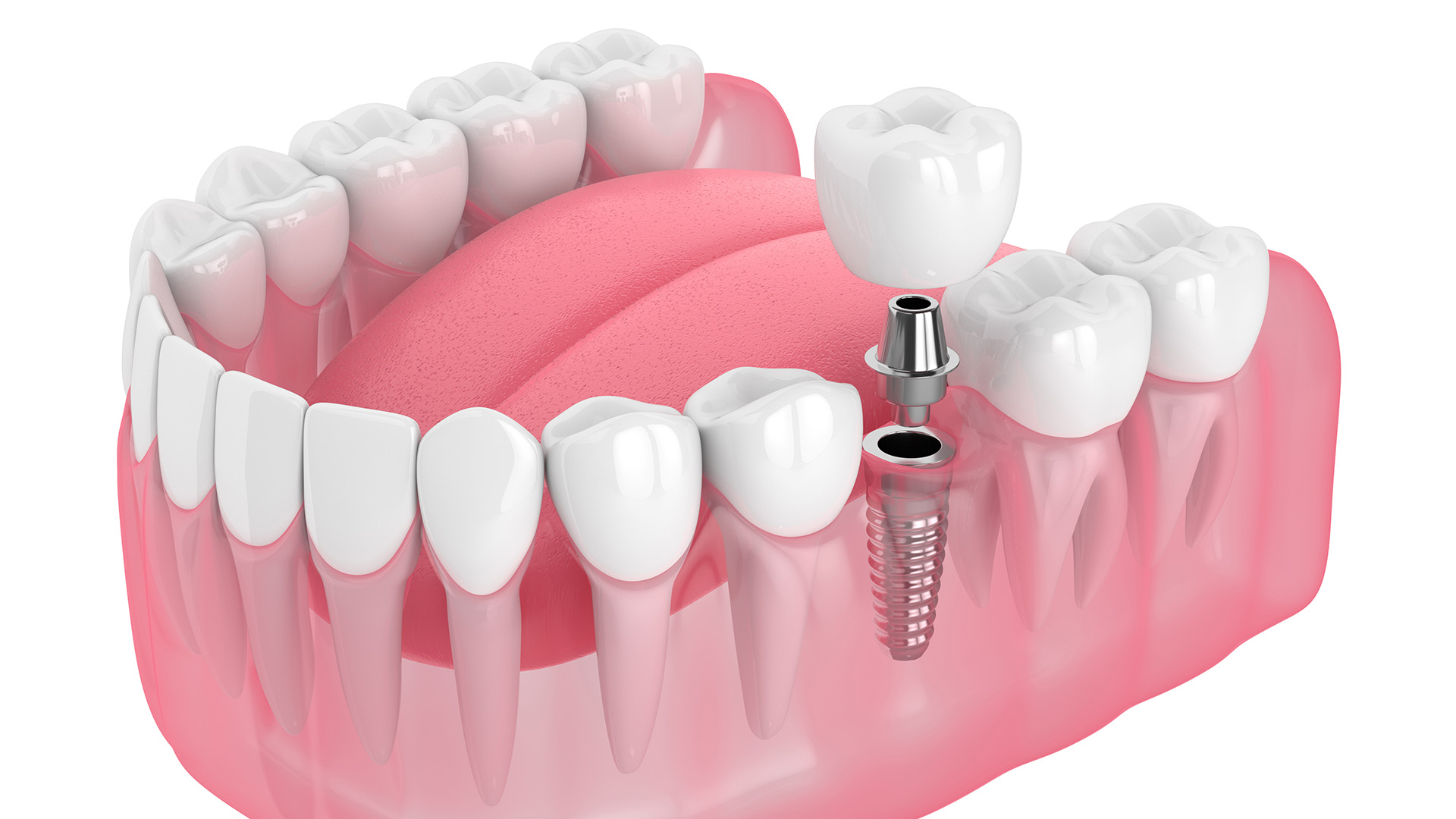 Dental Implants in Russellville AR
