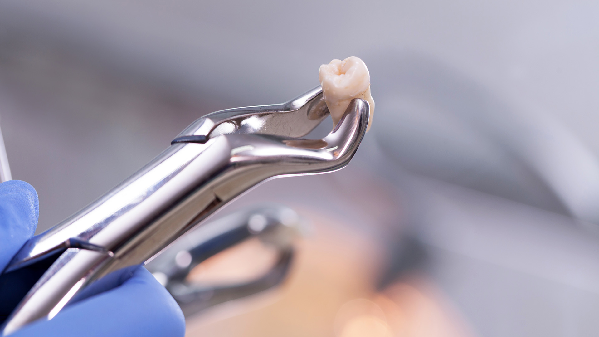 Tooth Extractions in Russellville, AR
