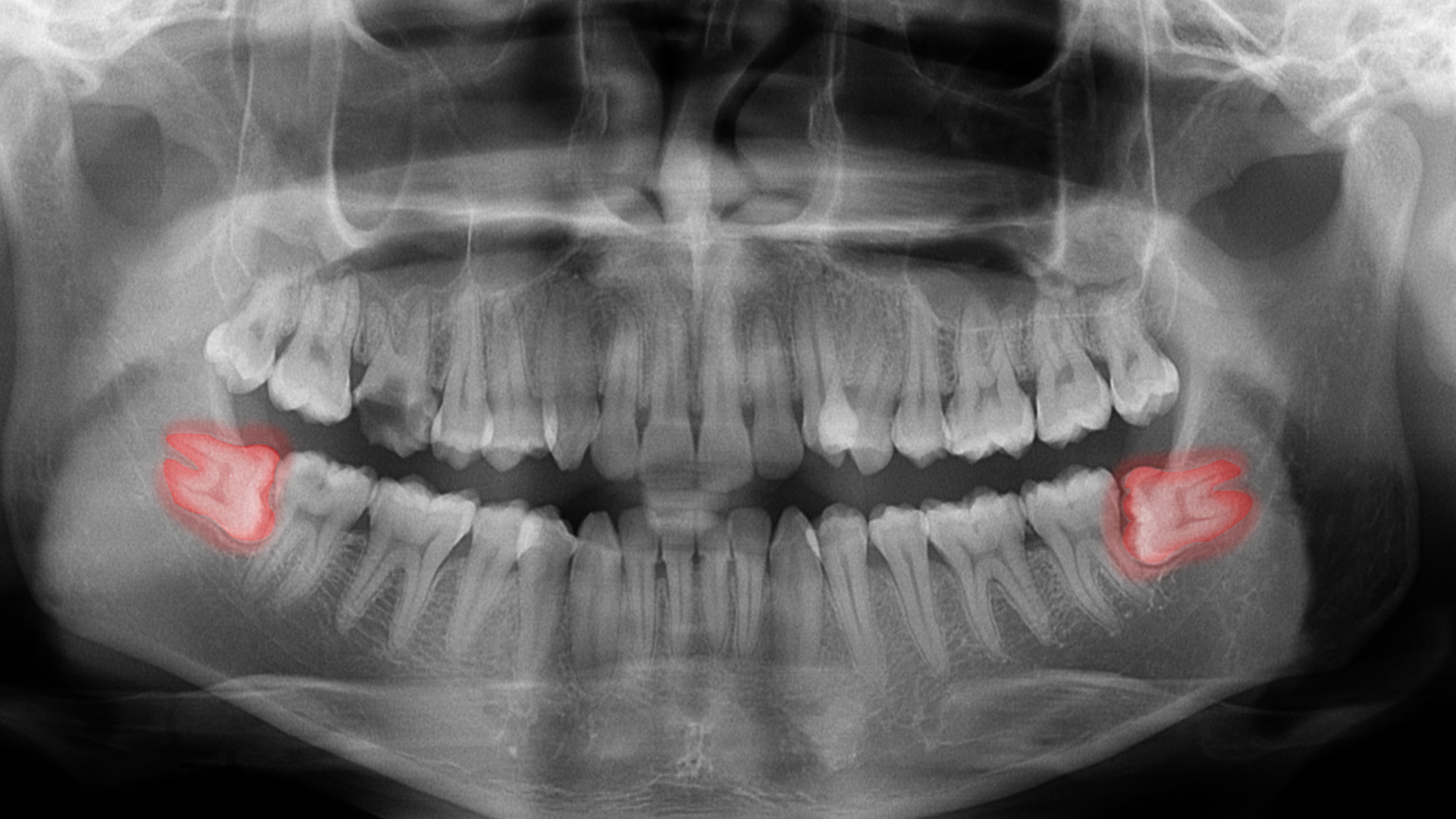 Wisdom Tooth Extractions in Russellville AR